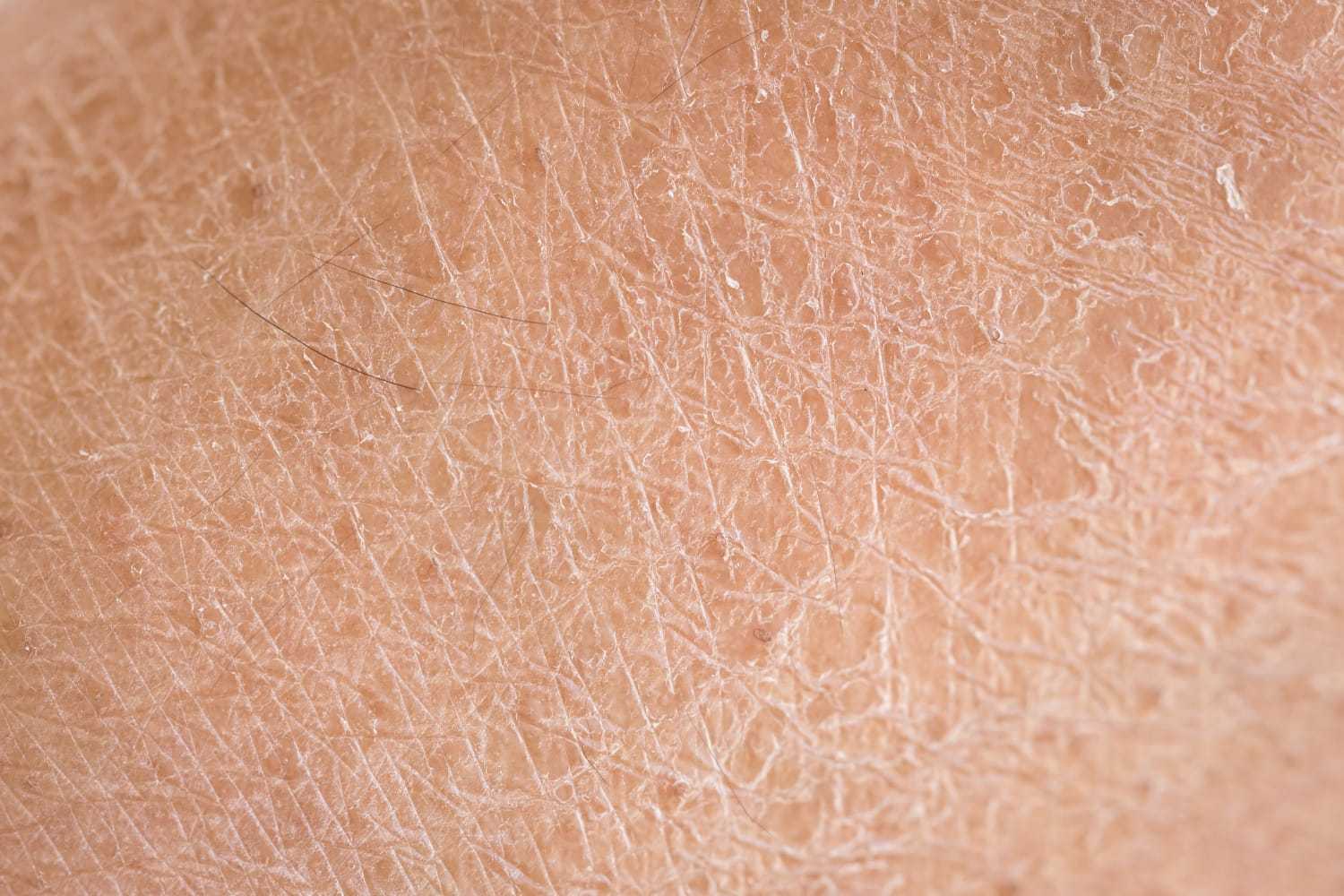 Close-up of dry skin with visible flaking and texture.