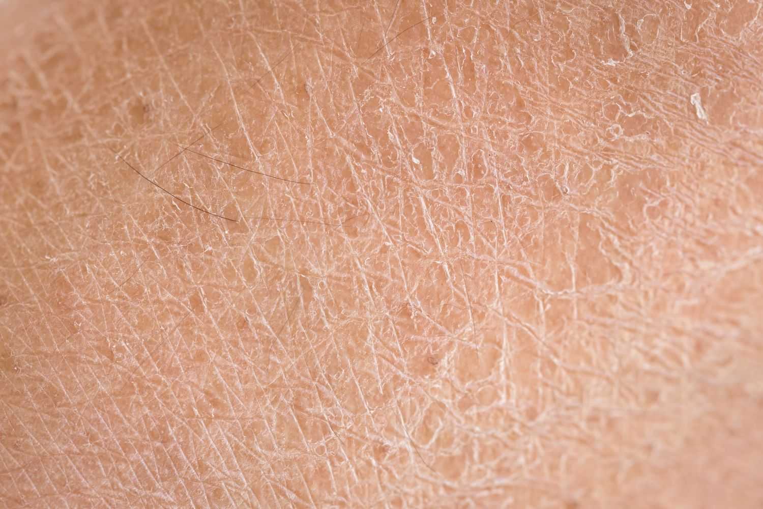 Close-up of dry skin with visible flaking and texture.